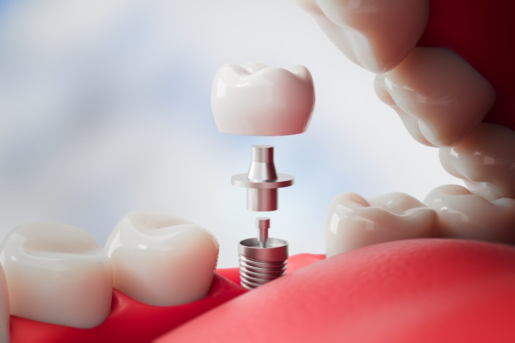 dental implants Wilton Manors